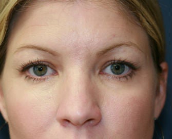 blepharoplasty