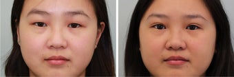 Double Eyelid (Asian Blepharoplasty) Incisional