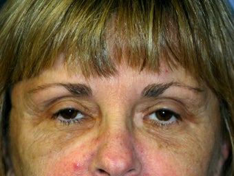 Blepharoplasty