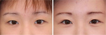 Double Eyelid Surgery - Suture Technique