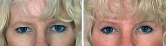 Blepharoplasty