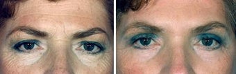 Blepharoplasty