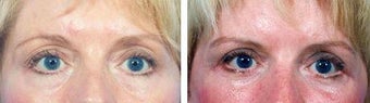 Blepharoplasty