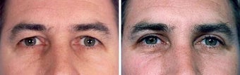 Blepharoplasty