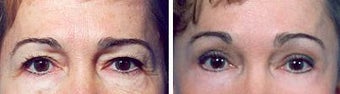 Blepharoplasty