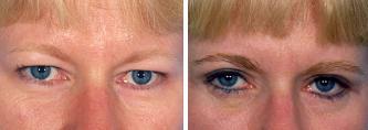 Blepharoplasty
