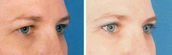 Blepharoplasty