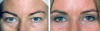 Blepharoplasty