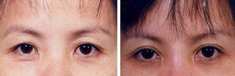 Blepharoplasty