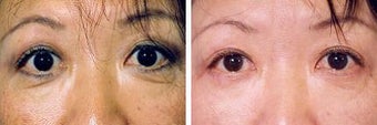 Blepharoplasty
