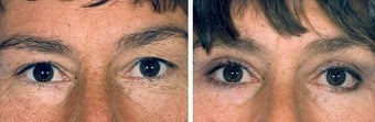 Blepharoplasty