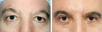 Belpharoplasty