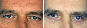 Blepharoplasty