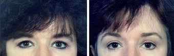 Belpharoplasty