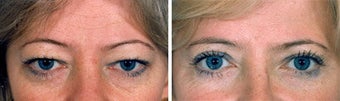 Blepharoplasty