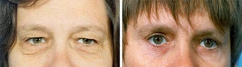 Blepharoplasty