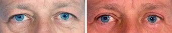Blepharoplasty
