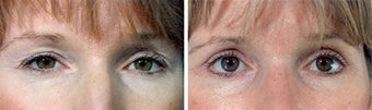 Blepharoplasty