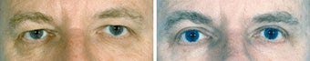 Blepharoplasty