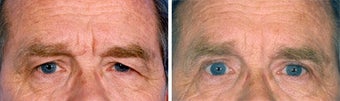 Blepharoplasty