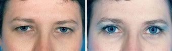 Blepharoplasty