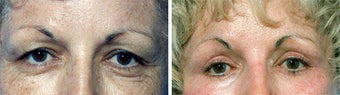 Blepharoplasty