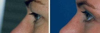 Blepharoplasty