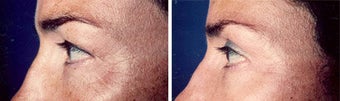Blepharoplasty