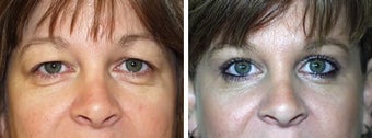 Blepharoplasty