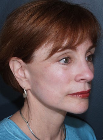 Vertical Facelift 