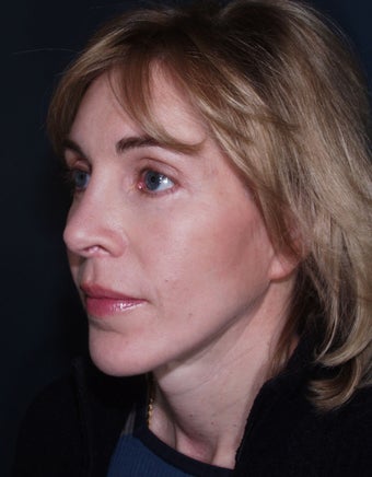 Laser used for cutting - Vertical Facelift
