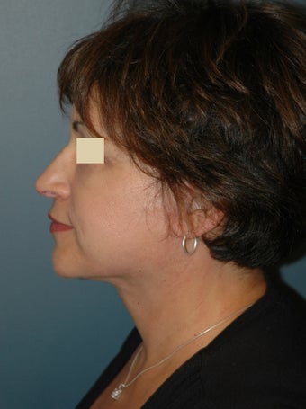 Facelift