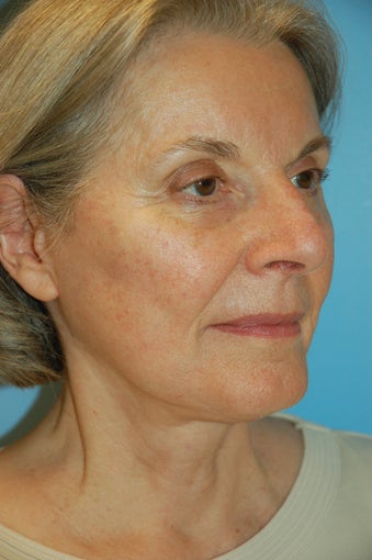Facelift