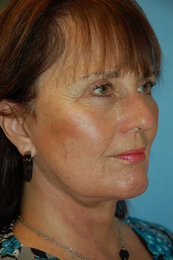 Facelift, Upper and Lower Blepharoplasty and Chin Implant