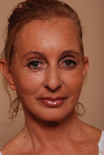 Stem Cell Enriched Facial Rejuvenation
