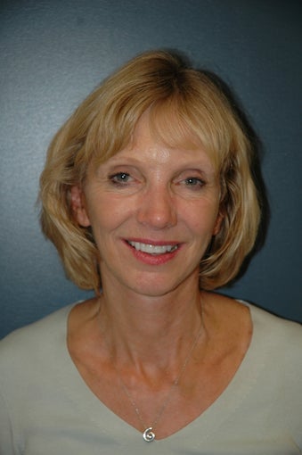 Facelift