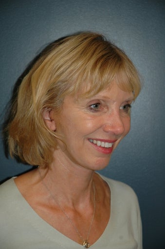 Facelift