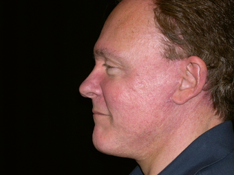 Facelift, Chin Implant, Browlift