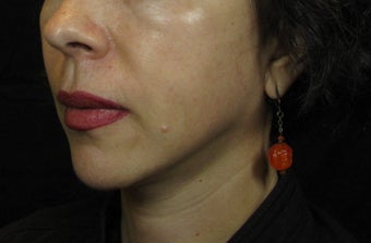 Facelift