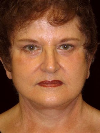 Complete faclift