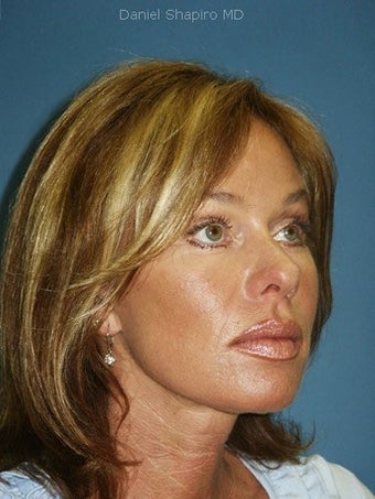 Facelift, Endoscopic Browlift, Upper and Lower Blepharoplasty