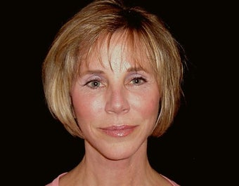 Full face , brow and eyelid lift,nose re-shaping,fat inj-face chin implant,lip agmentation,Tca chemical peel