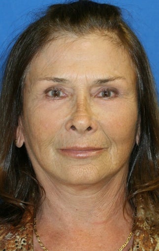 facelift