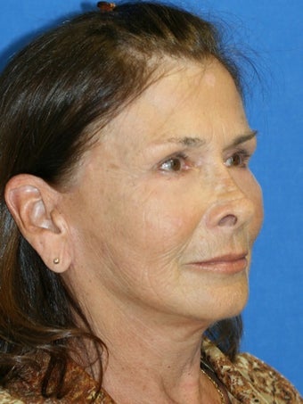 Facelift