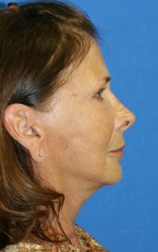 facelift