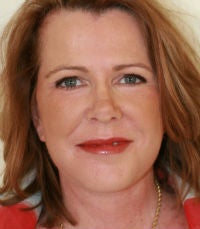 Facelift and laser resurfacing