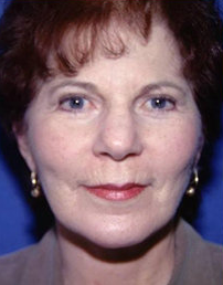 Facelift and Eyelid Surgery