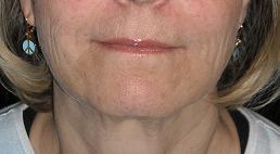 "Liquid facelift" with filler