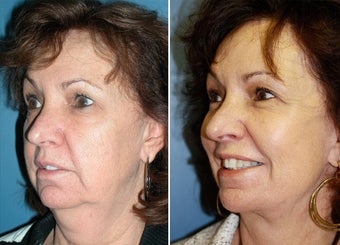Faceilft and platysmaplasty