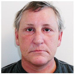 Upper and lower eyelid surgery, face lift, neck lift, and brow lift.
